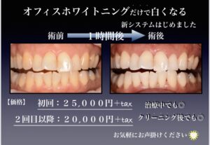 ホワイトニング変わりました